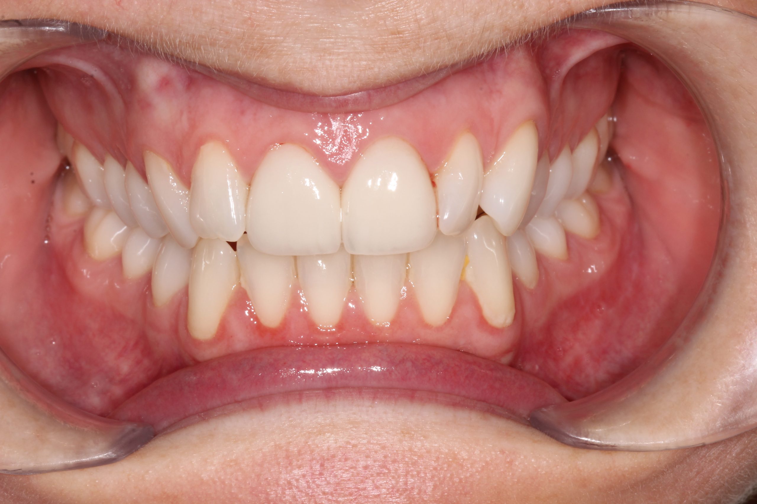 Chipped Front Teeth & Symmetry Restoration
