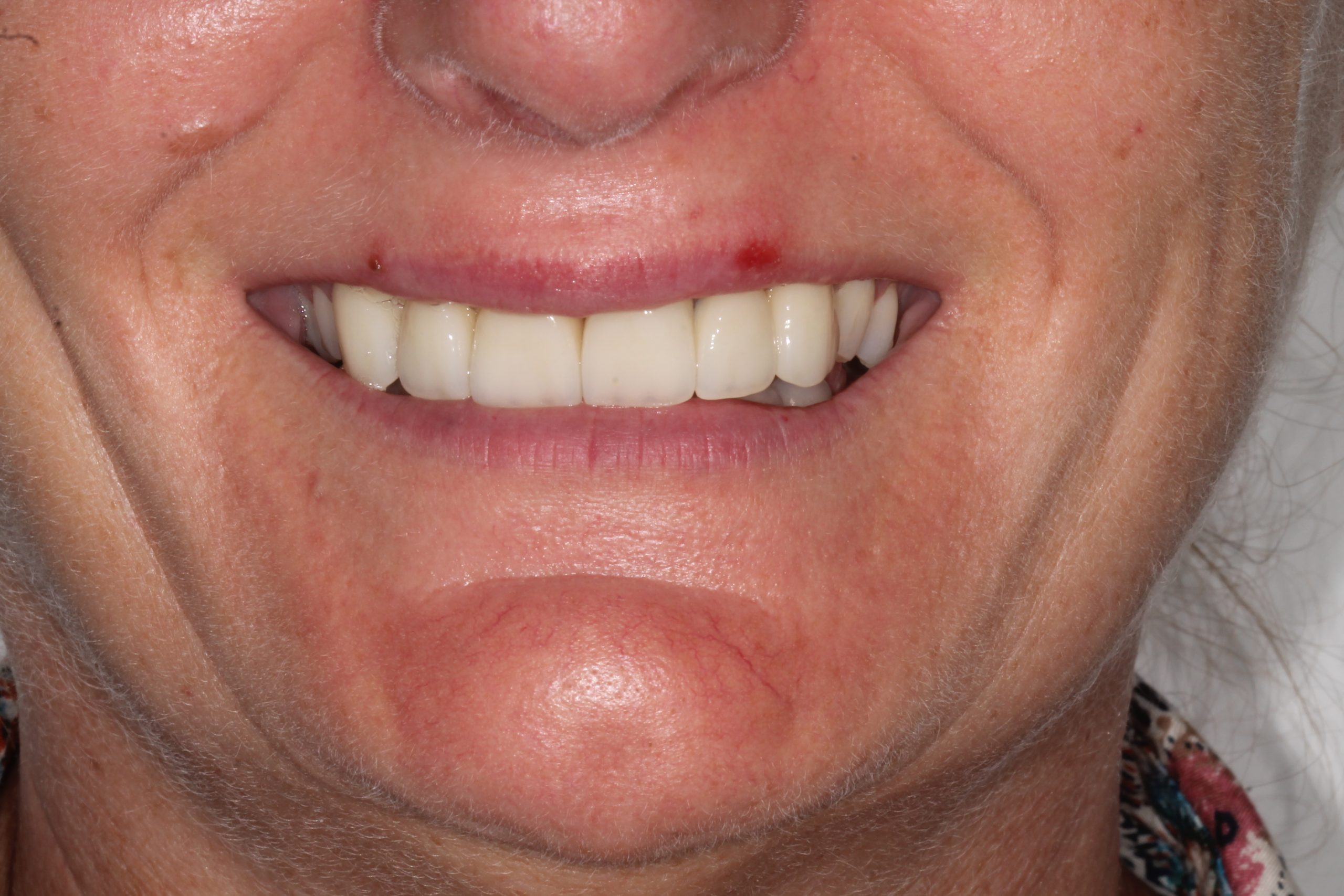 Invisalign Aligners After Case