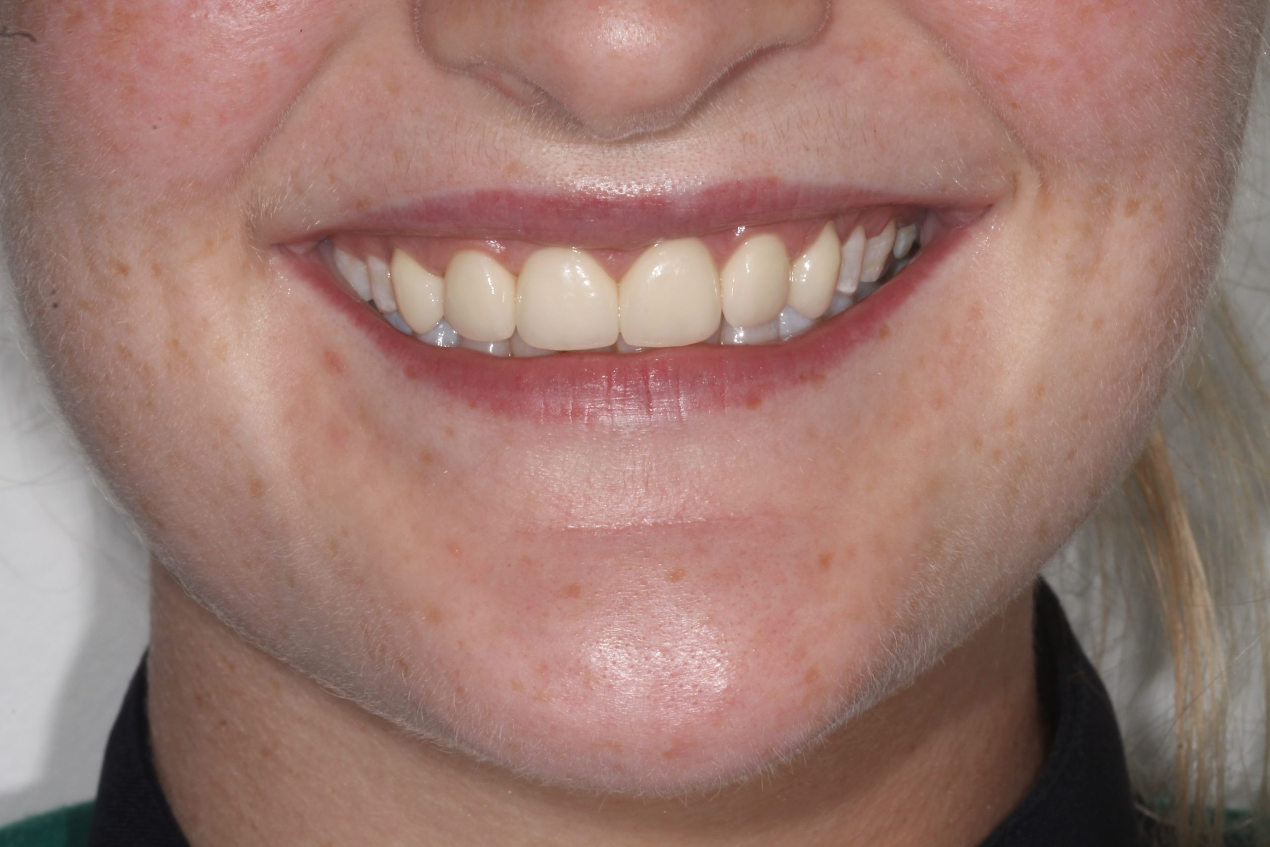 Deep Overbite & Canine Correction
