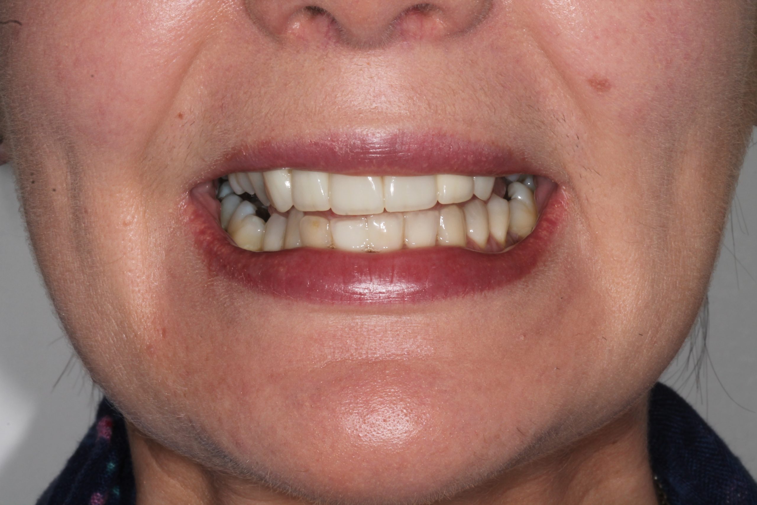 Complete Enamel & Shade Transformation