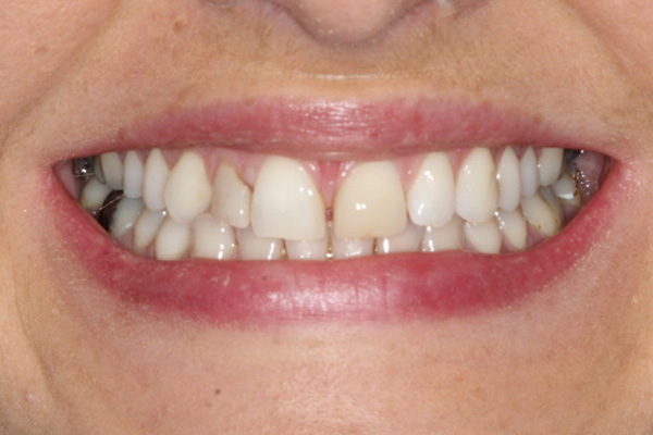 Composite Bonding Before Case