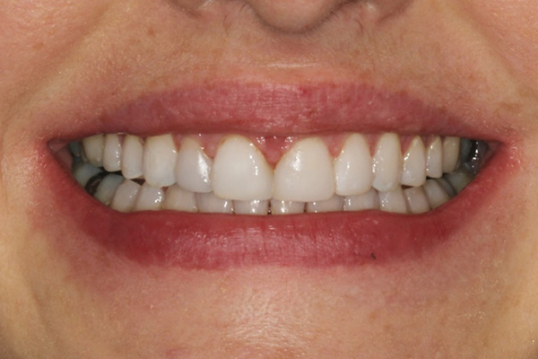 Composite Bonding After Case