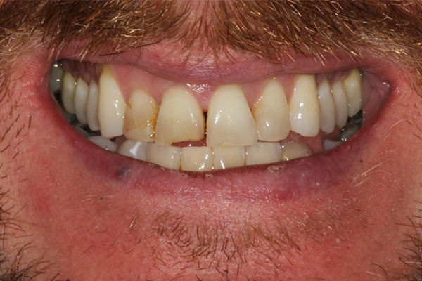 Composite Bonding Before Case