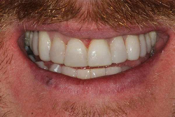 Composite Bonding After Case