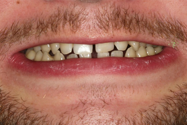Porcelain Veneers Before Case