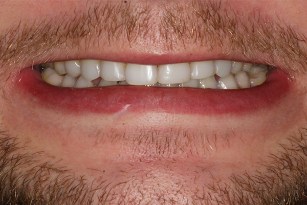 Porcelain Veneers After Case