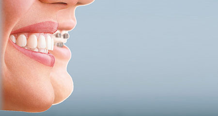 Professional Teeth Whitening